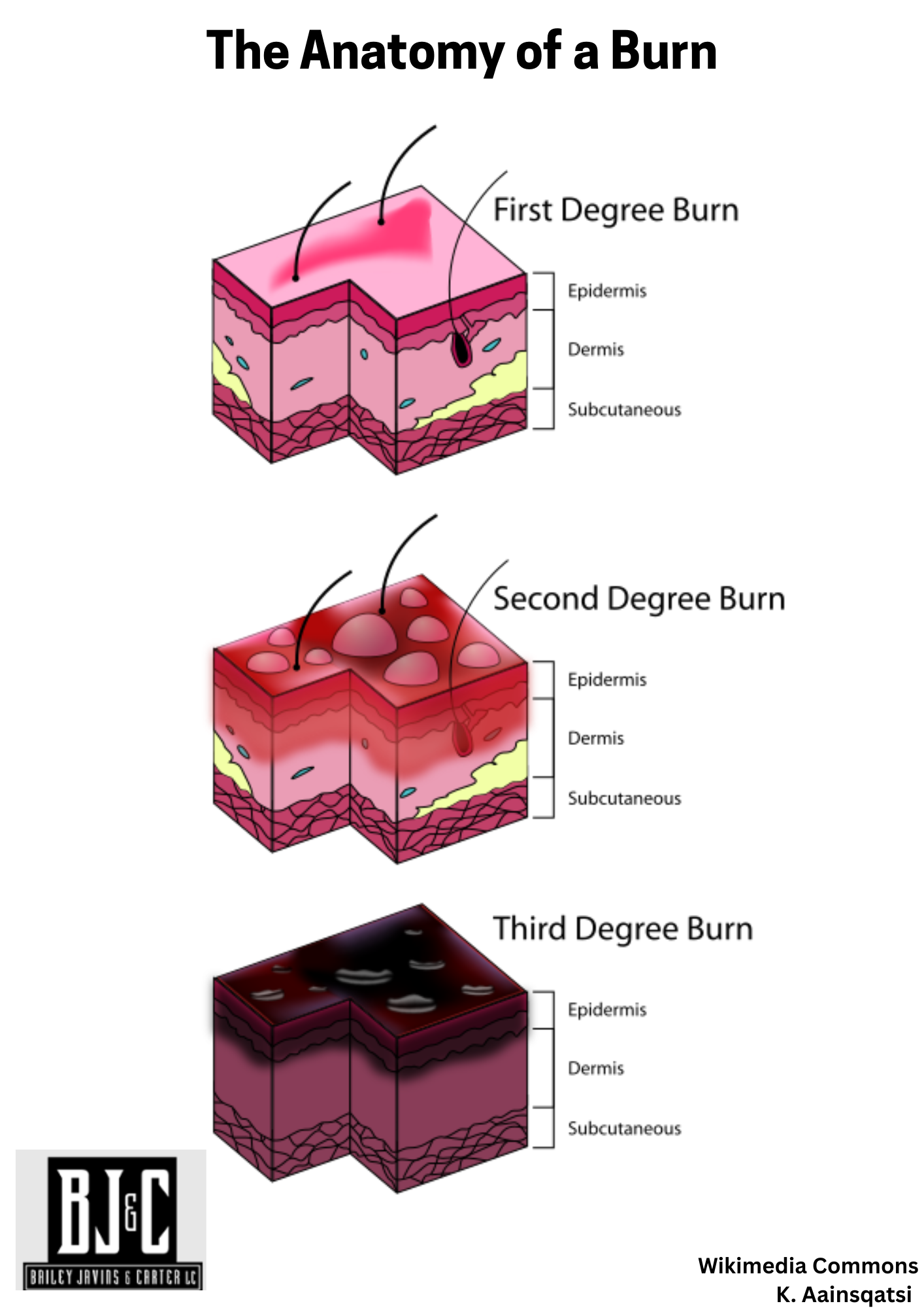 Types of Burns