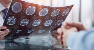 Catastrophic Brain Injuries
